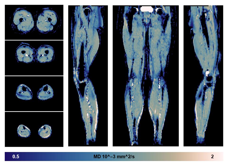 IVIM corrected whole leg muscle mean diffusivity obtained from diffusion tensor imaging.